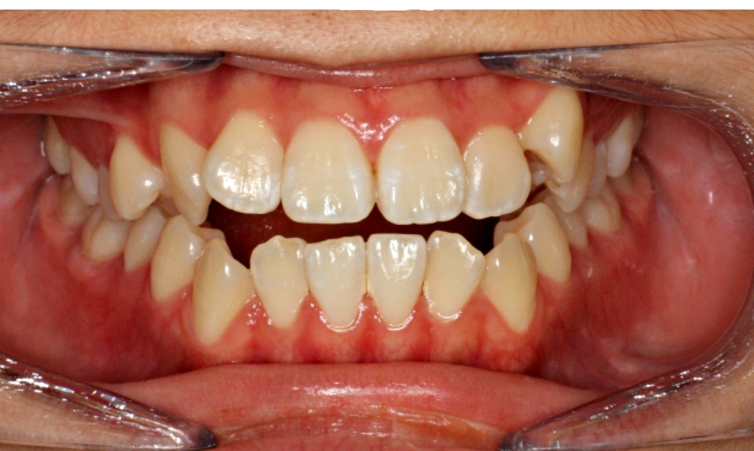 Improper Overlap Of Teeth Rix Orthodontics Calgary AB